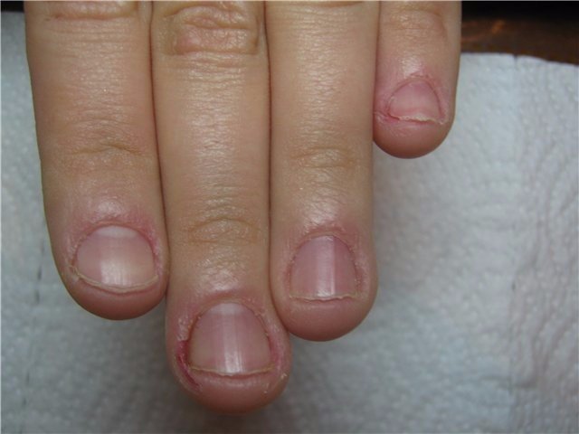 Как перестать  грызть ногти?