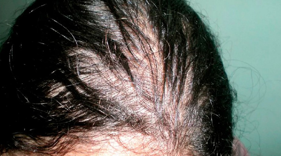 Что надо знать о витамине B12 для волос