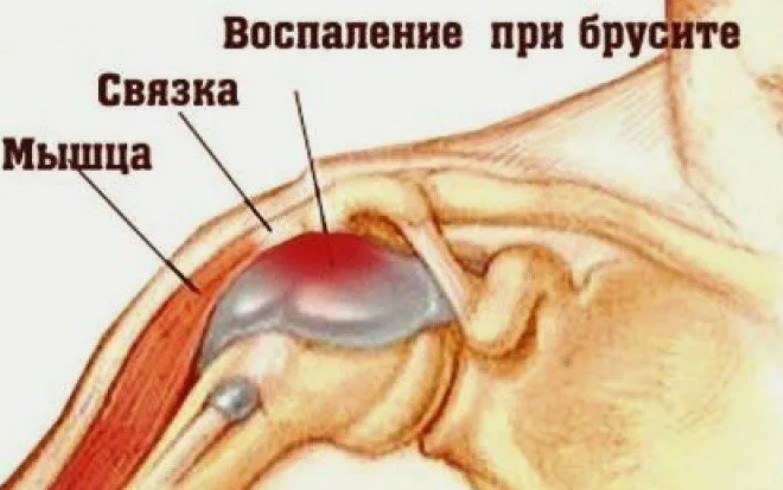 Что такое бурсит и отчего он возникает