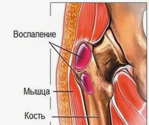 Что такое бурсит и отчего он возникает