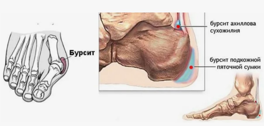 Что такое бурсит и отчего он возникает