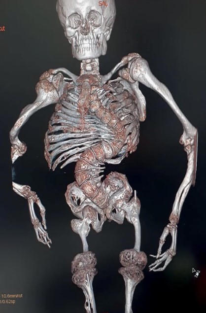 Как понять, что у тебя несовершенный остеогенез