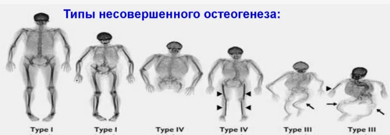 Как понять, что у тебя несовершенный остеогенез