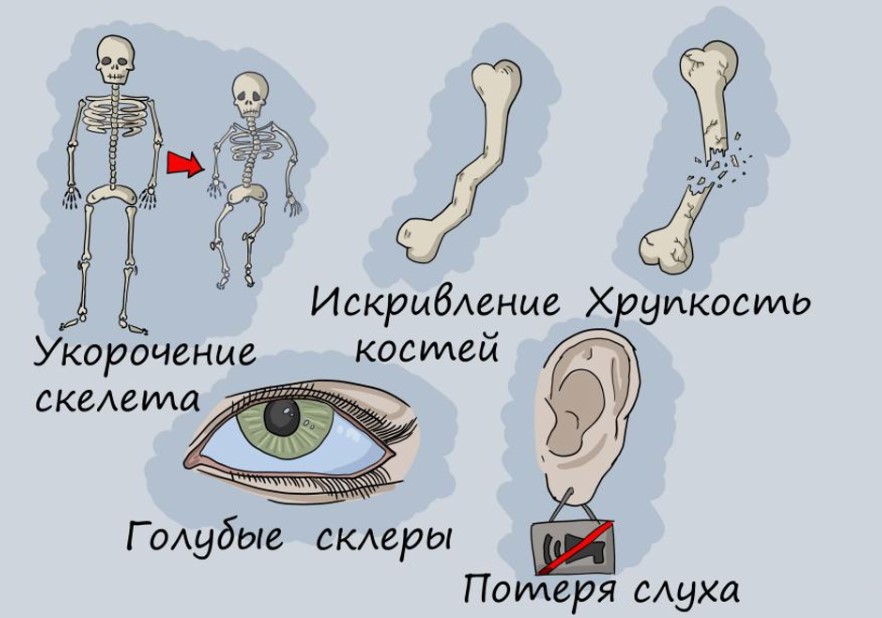 Как понять, что у тебя несовершенный остеогенез
