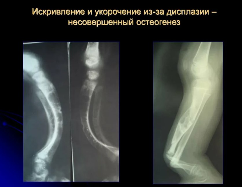 Как понять, что у тебя несовершенный остеогенез