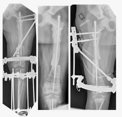 Как понять, что у тебя несовершенный остеогенез