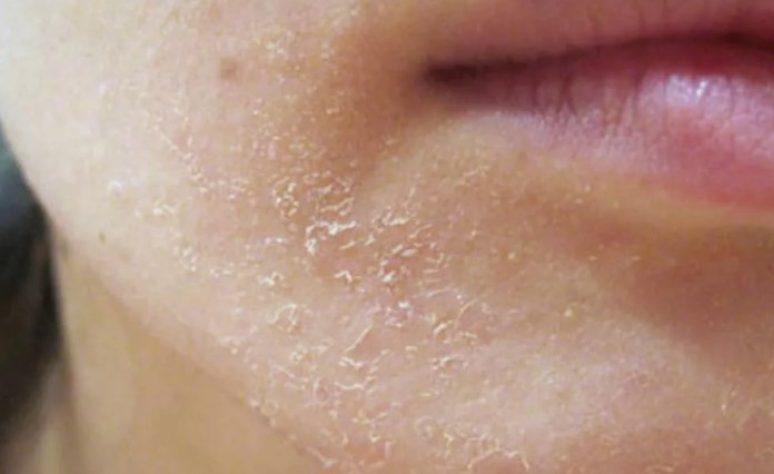 Как предотвратить сухость кожи у человека