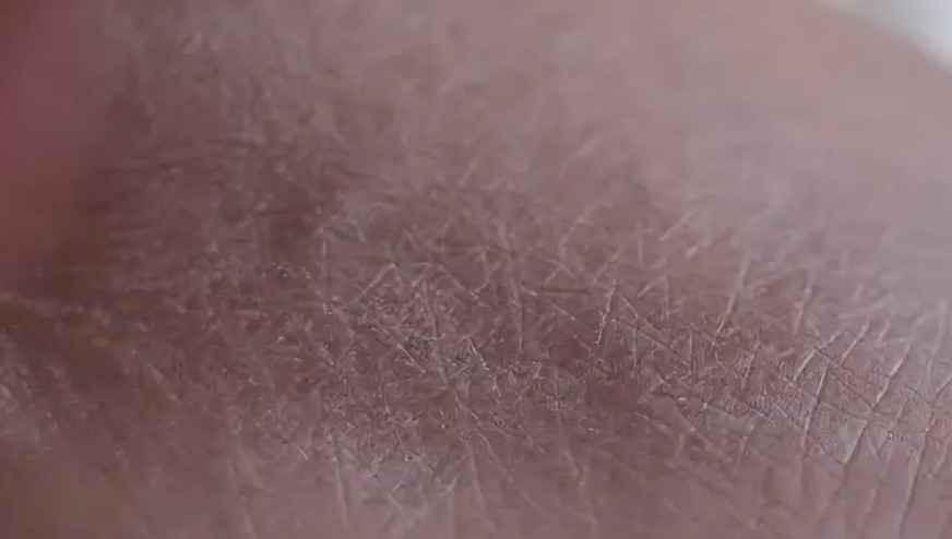 Как предотвратить сухость кожи у человека