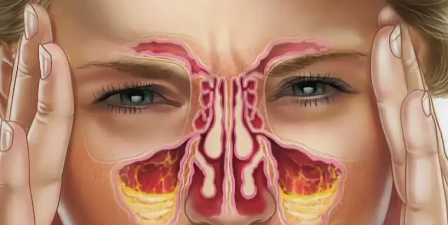 Что за болезнь синусит и чем опасна