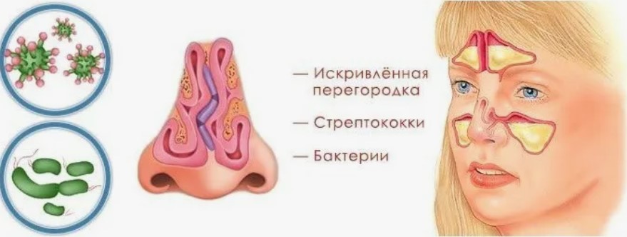 Что за болезнь синусит и чем опасна