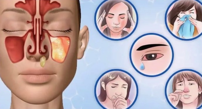 Что за болезнь синусит и чем опасна